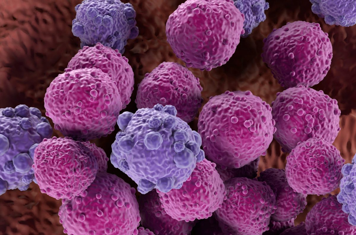 Lymphoma is a group of blood and lymph tumors that develop from lymphocytes (a type of white blood cell). The name typically refers to just the cancerous versions rather than all such tumours.